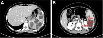 Case report: a case of multiple splenic abscesses in a child and literature review